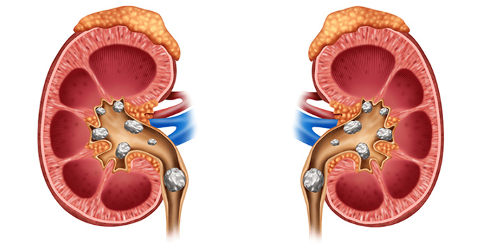 PCNL Surgery: Safe Kidney Stone Removal Procedure
