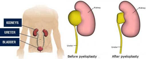 Pyeloplasty Surgery: Procedure, Recovery, and Benefits Explained