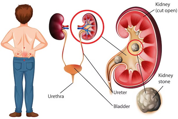 The Basics of Urology: What Happens During Stone Surgery?
