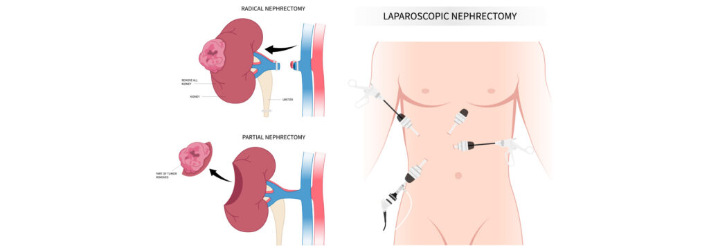 Essential Surgical Instruments Used in Nephrectomy Procedures