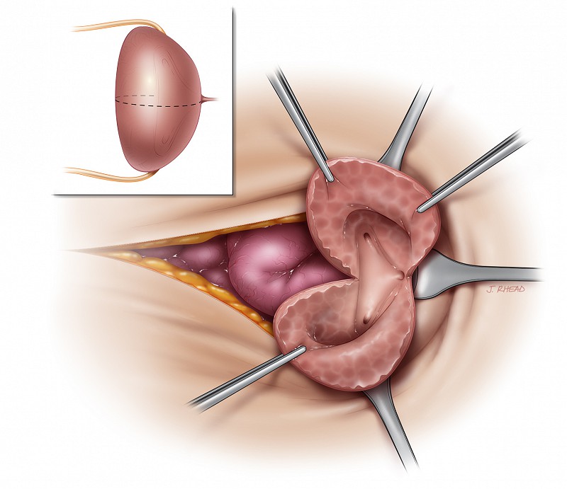 Instruments Used in Bladder Augmentation Surgery: Step-by-Step Guide