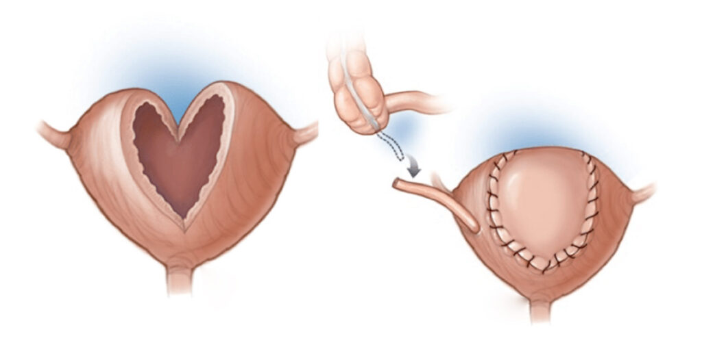 Bladder Augmentation Surgery: Procedure, Benefits & Recovery Guide