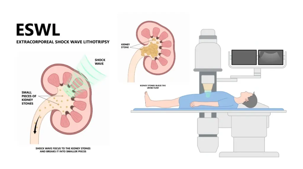Instruments in Shock Wave Lithotripsy (SWL) for Kidney Stones