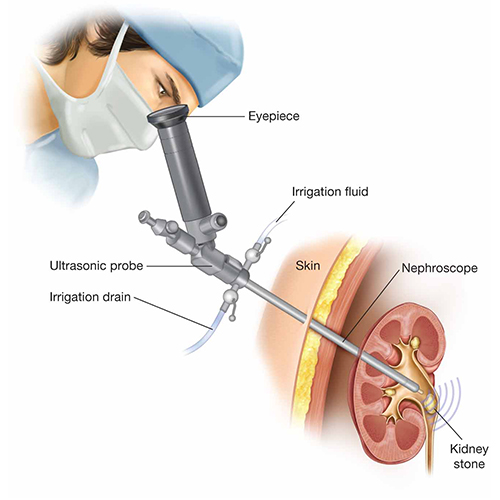Instruments Used in Percutaneous Nephrolithotomy(PCNL) Surgery