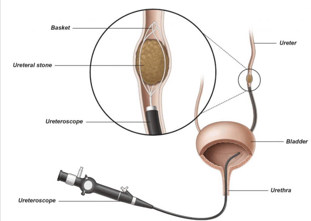 Ureteroscopy (URS) Procedure: Steps, Benefits, and Recovery