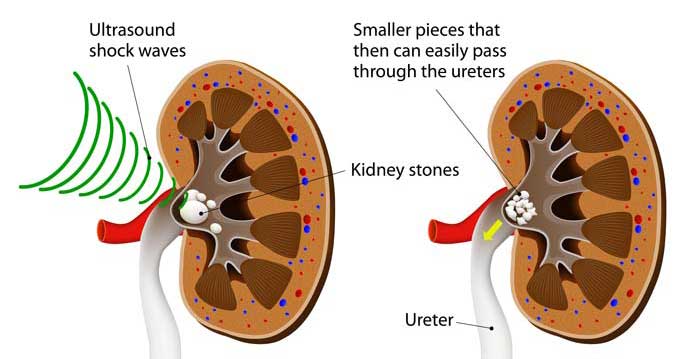Shock Wave Lithotripsy (SWL): Guide to Procedure & Recovery