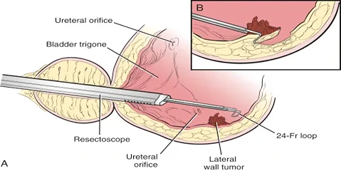 Instruments Used in TURBT (Transurethral Resection of Bladder Tumor) Surgery