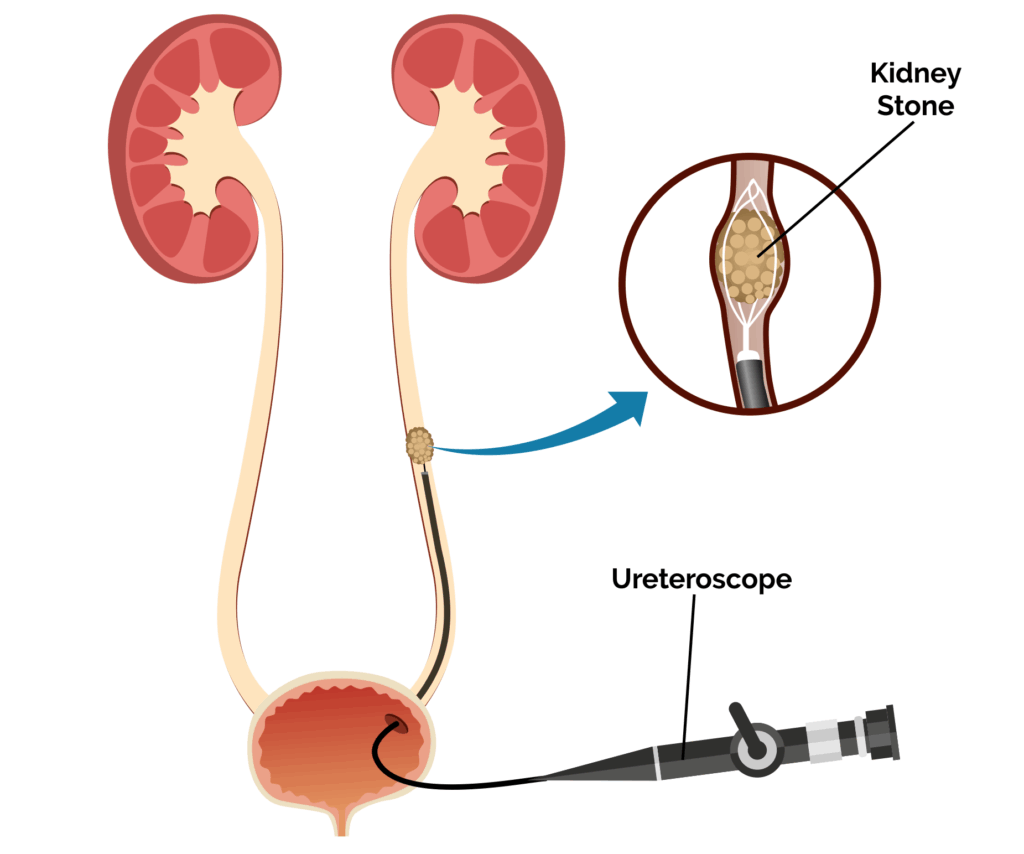 Key Instruments in Ureteroscopy (URS) for Effective Treatment