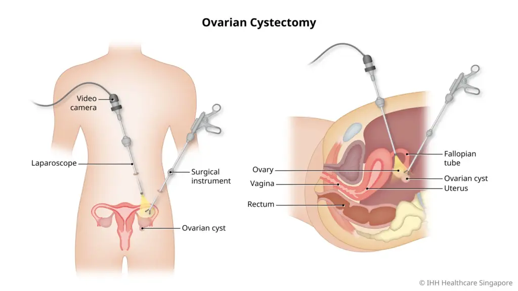 Cystectomy Surgery: Procedure, Types, Recovery & Risks Explained