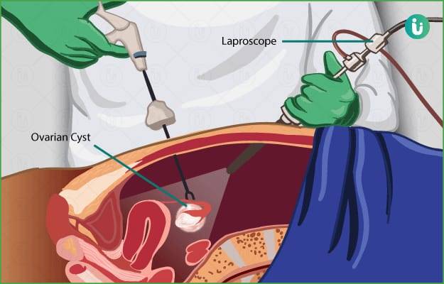 Instruments Used in Cystectomy Surgery: A Complete Guide